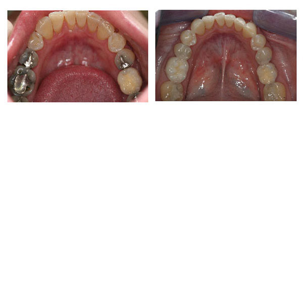 Amalgam Removal Before and After