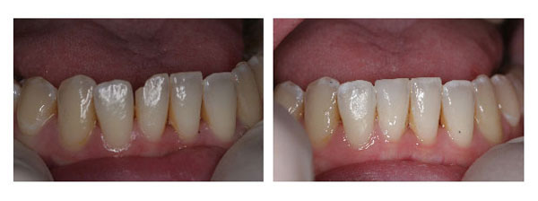 Chipped Tooth Repair Before and After